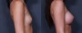 Dr. Saltz Inverted Nipple Patient 1