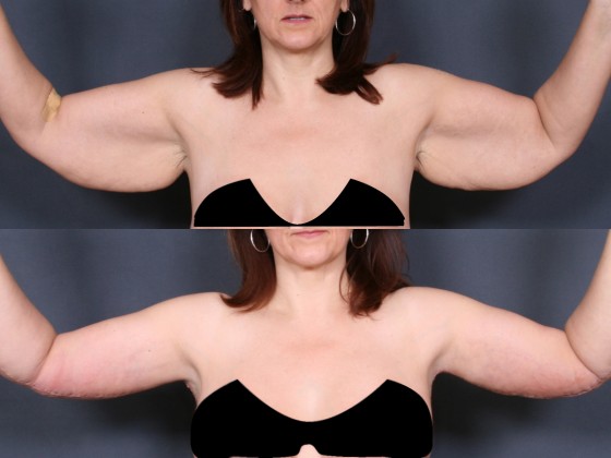Dr. Saltz Upper Arm Lift Patient 1