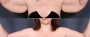 Dr. Saltz Upper Arm Lift Patient 1