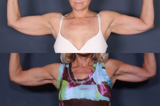 Dr. Roark Upper Arm Lift Patient 1