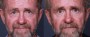 Dr. Brahme Forehead Lift Patient 2