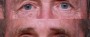 Dr. Brahme Eyelid Lift Patient 9