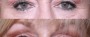 Dr. Brahme Eyelid Lift Patient 10