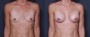Dr. Saltz Breast Augmentation Patient 79