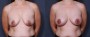 Dr. Roark Breast Augmentation with Lift Patient 6