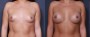 Dr. Saltz Breast Augmentation Patient 74