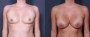 Dr. Saltz Breast Augmentation Patient 75