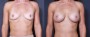 Dr. Saltz Breast Augmentation Patient 76