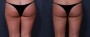 Dr. Saltz Liposuction Patient 6