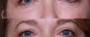 Dr. Brahme Eyelid Lift Patient 11