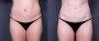 Dr. Roark Tummy Tuck Patient 15