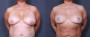 Dr. Roark Breast Reduction Patient 3