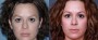 Dr. Roark Rhinoplasty Patient 4