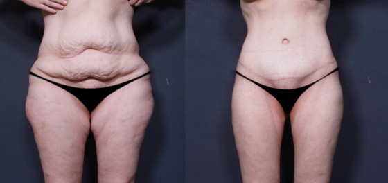 Dr. Brahme Body Lift Patient 1