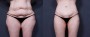 Dr. Brahme Body Lift Patient 1