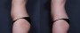 Dr. Roark Liposuction Patient 4