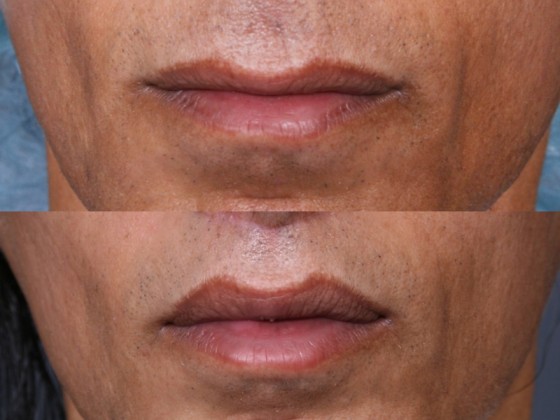 Dr. Brahme Lip Enhancement Patient 1