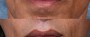 Dr. Brahme Lip Enhancement Patient 1