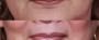 Dr. Brahme Lip Enhancement Patient 2