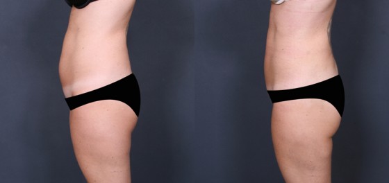 Dr. Brahme Liposuction Patient 1
