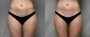 Dr. Saltz Liposuction Patient 3