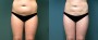 Dr. Brahme Liposuction Patient 4