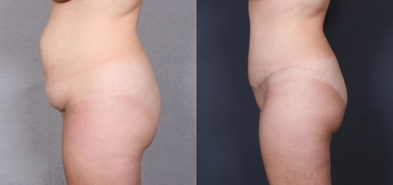 Dr. Roark Tummy Tuck Patient 1