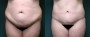 Dr. Roark Tummy Tuck Patient 3