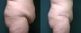 Dr. Roark Tummy Tuck Patient 4
