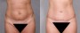 Dr. Roark Tummy Tuck Patient 7