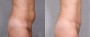 Dr. Roark Tummy Tuck Patient 9