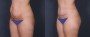Dr. Roark Tummy Tuck Patient 10