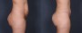 Dr. Roark Tummy Tuck Patient 11
