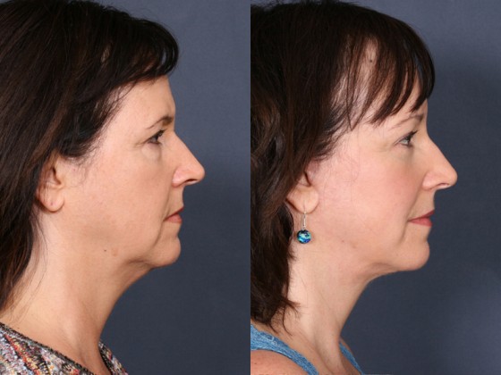 Dr. Roark Forehead Lift Patient 1