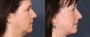 Dr. Roark Eyelid Lift Patient 5
