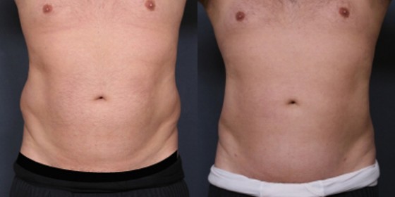 Dr. Saltz Male Liposuction Patient 1