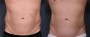 Dr. Saltz Male Liposuction Patient 1