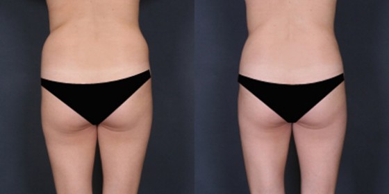Dr. Saltz Liposuction Patient 1