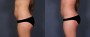 Dr. Brahme Liposuction Patient 3