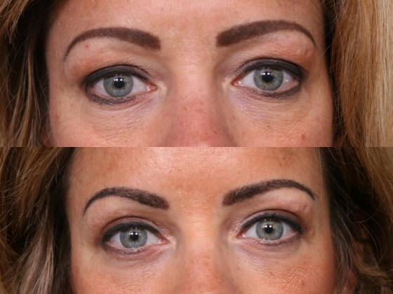 Dr. Saltz Eyelid Lift Patient 1