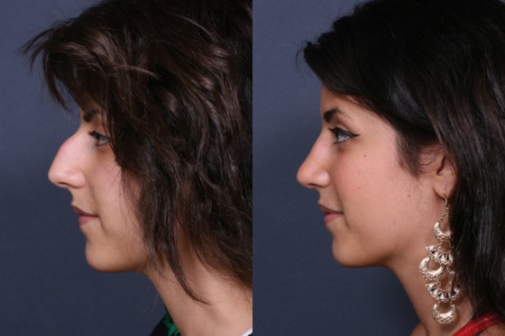 Dr. Brahme Rhinoplasty Patient 1