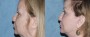 Dr. Roark Eyelid Lift Patient 4