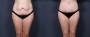 Dr. Brahme Tummy Tuck Patient 6