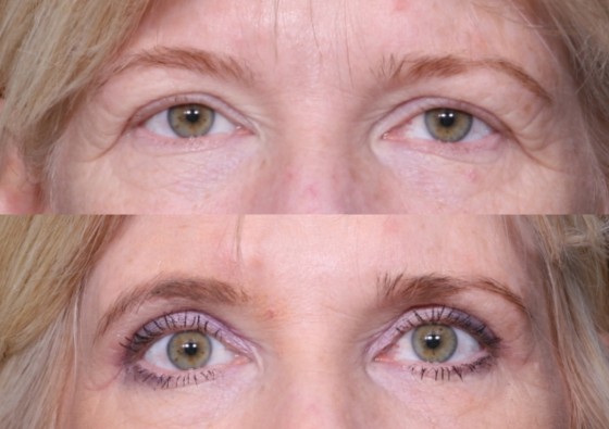 Dr. Brahme Eyelid Lift Patient 1