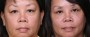 Dr. Brahme Eyelid Lift Patient 5
