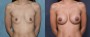 Dr. Roark Breast Augmentation Patient 8