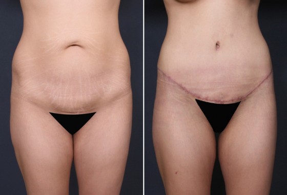 Dr. Brahme Tummy Tuck Patient 1