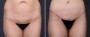 Dr. Brahme Tummy Tuck Patient 1