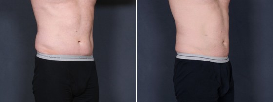 Dr. Brahme Male Liposuction Patient 1