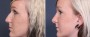 Dr. Brahme Rhinoplasty Patient 2